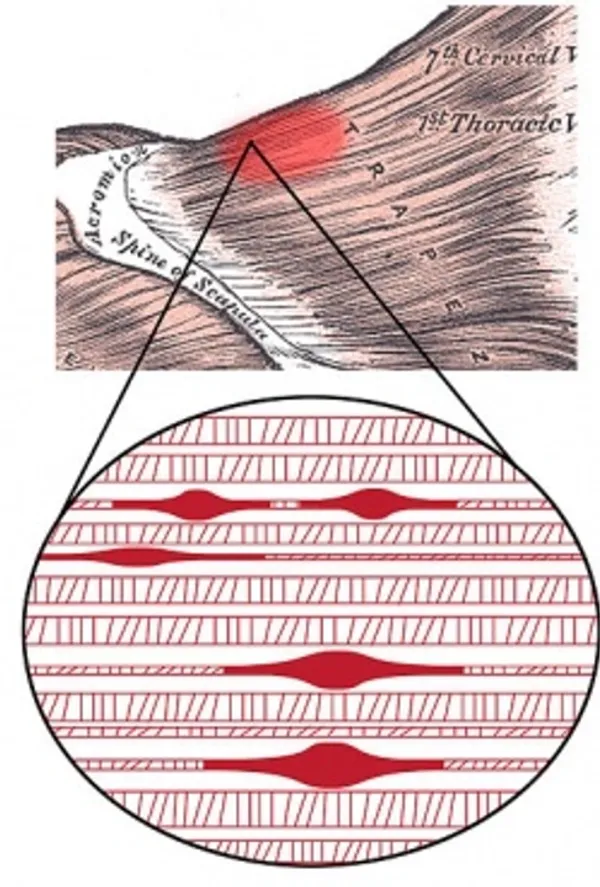 Trigger Point Therapy